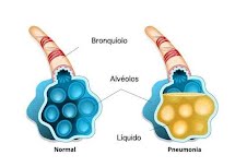 Dia Mundial da Pneumonia cuide-se